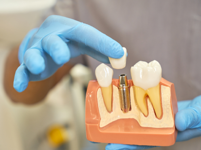 Dental Implants