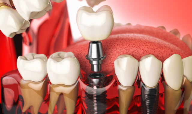 Dental Implants