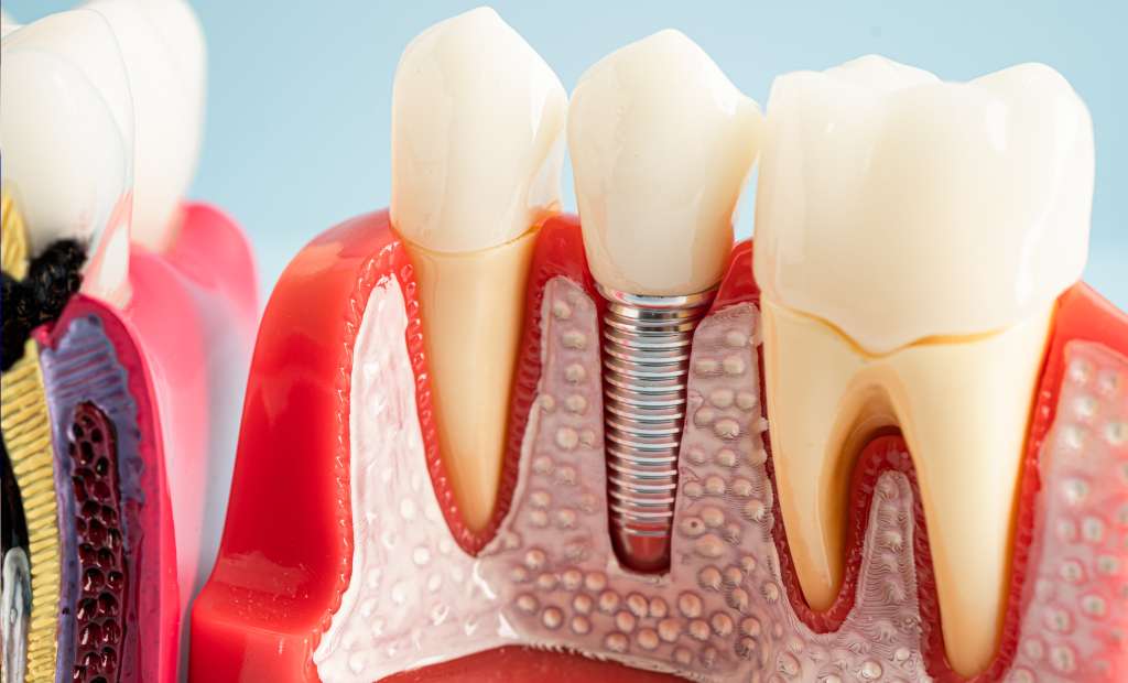 dental implants