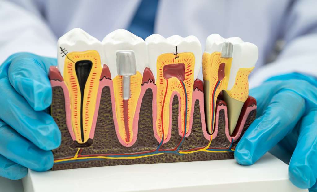 root canal