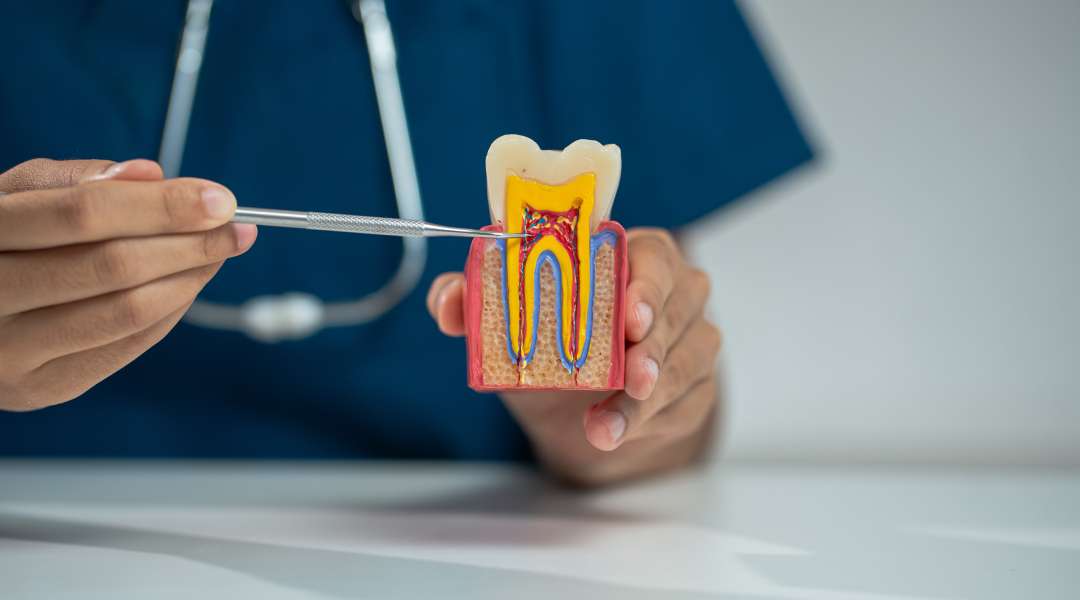 Root Canal Therapy