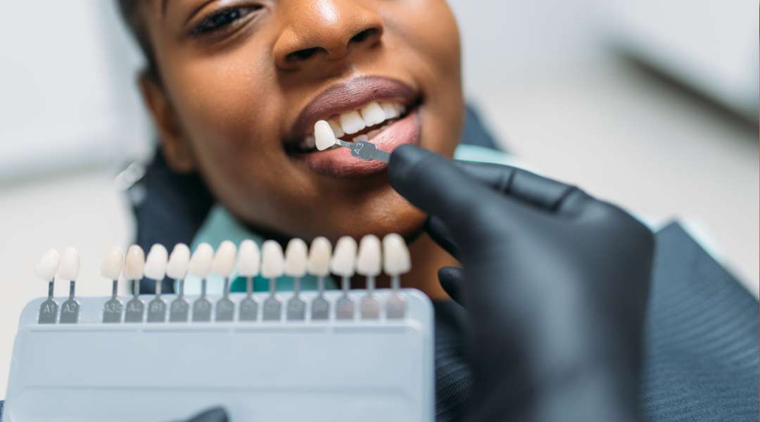 Porcelain Veneer Placement