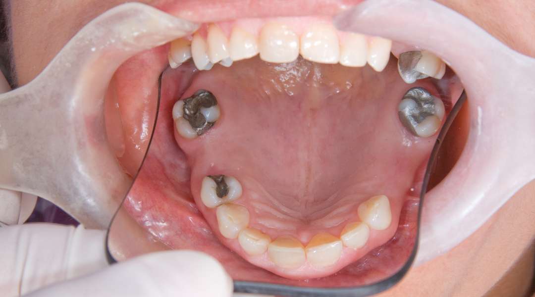 dental bridge
