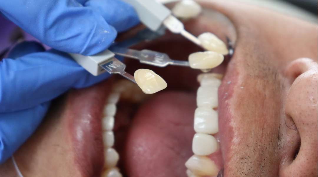 dental crown
