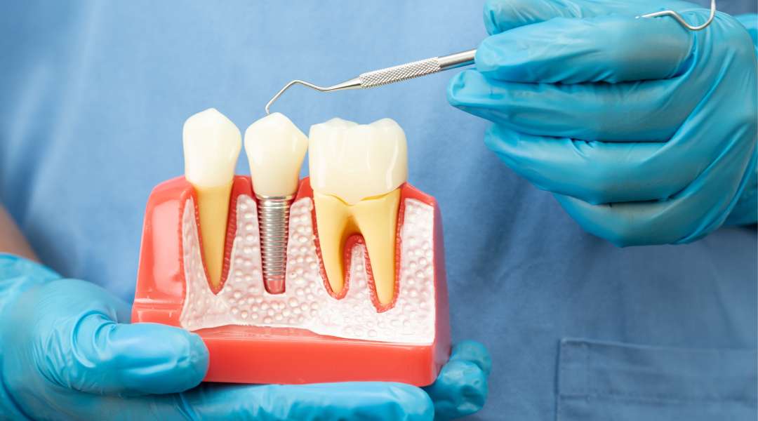 dental implant restoration