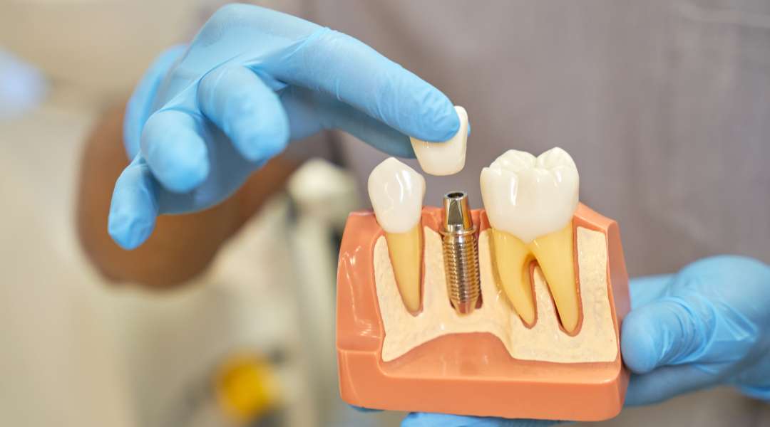 tooth implant placement