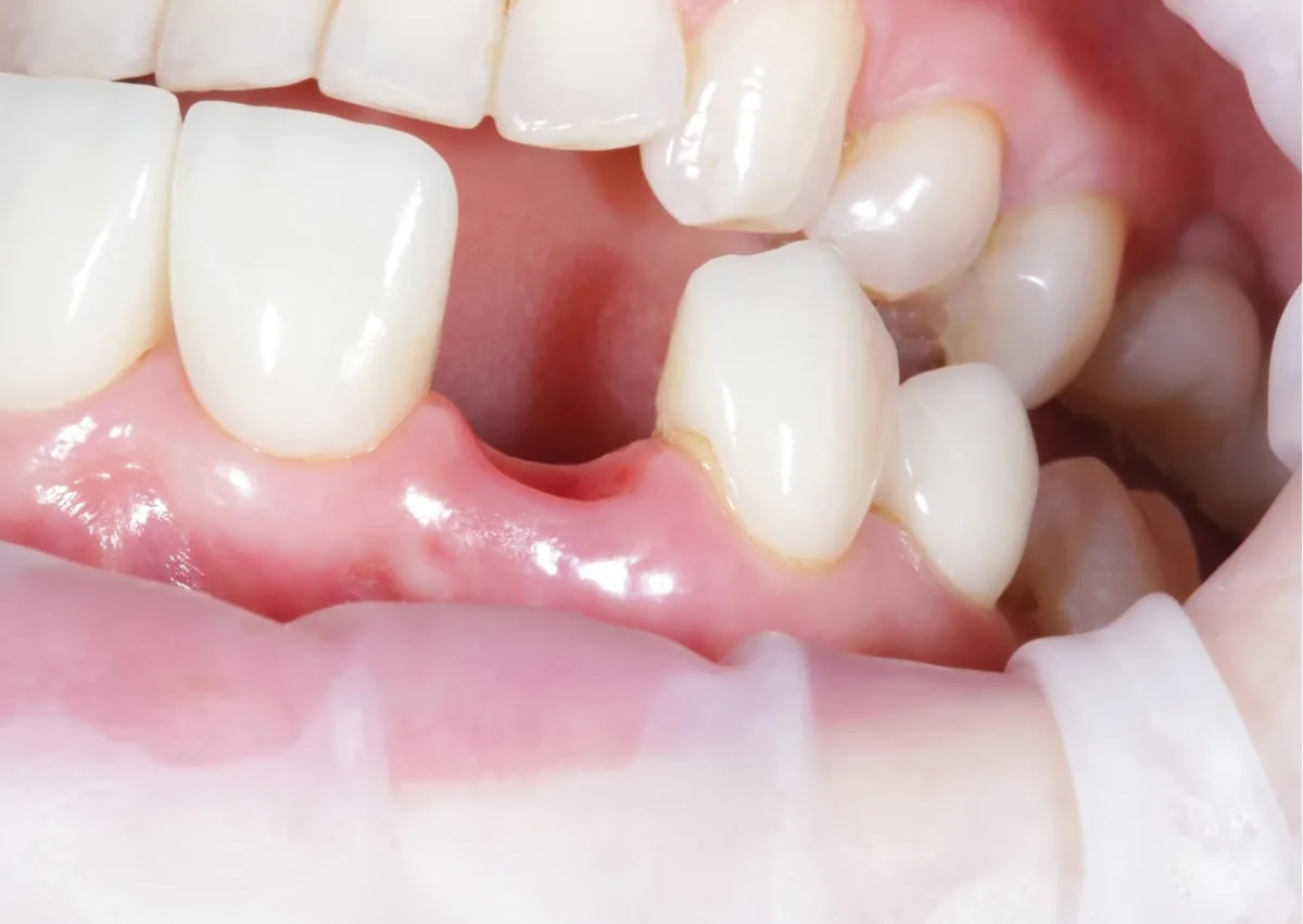 Close-up of an empty tooth socket after extraction showing the area where dry socket can develop.