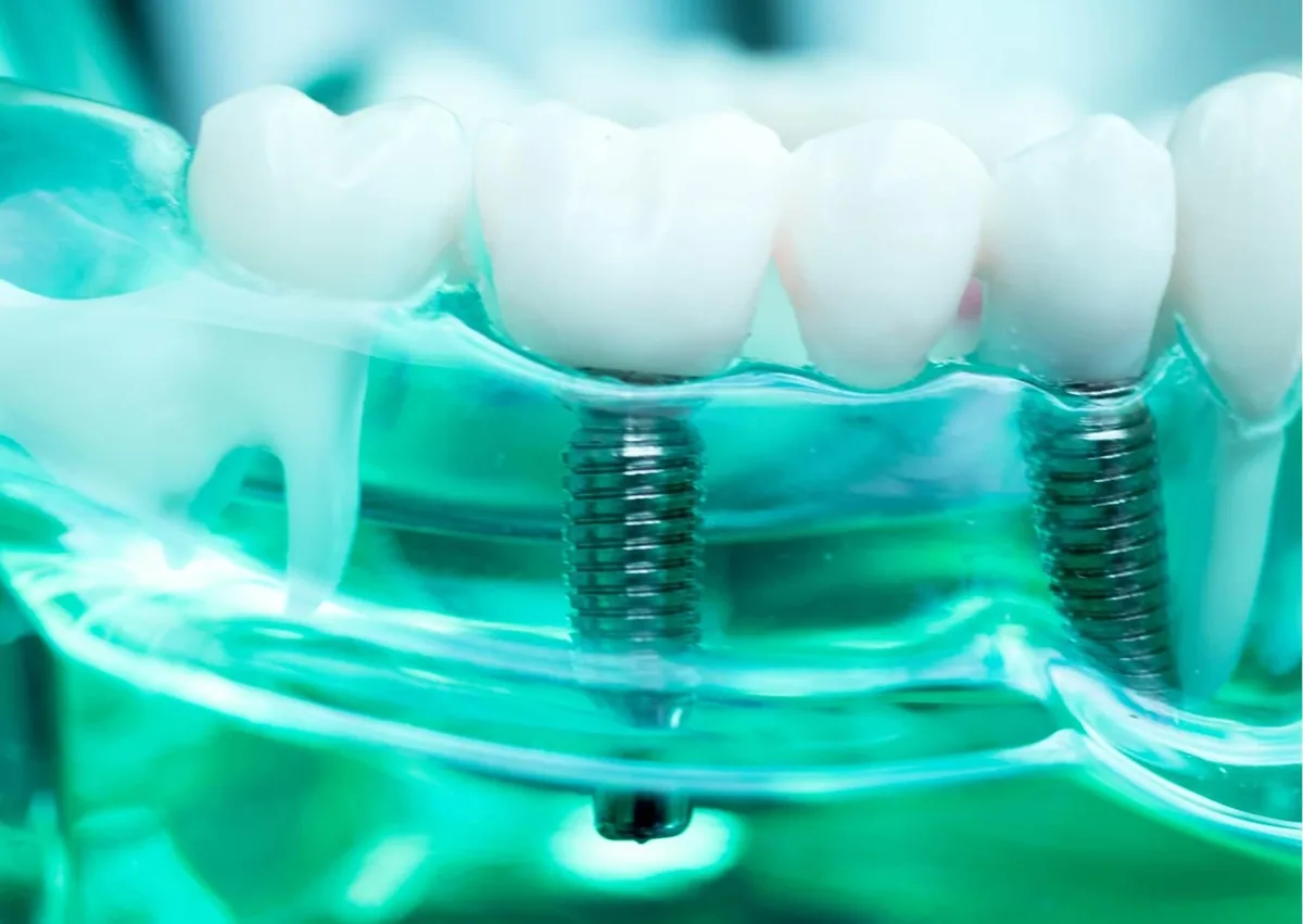 Dental implant model showing implant-supported replacement teeth and how dental implants provide long-term tooth replacement.