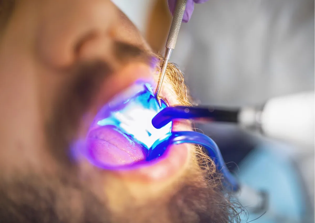 Dentist applying and curing a tooth-colored composite filling during treatment.