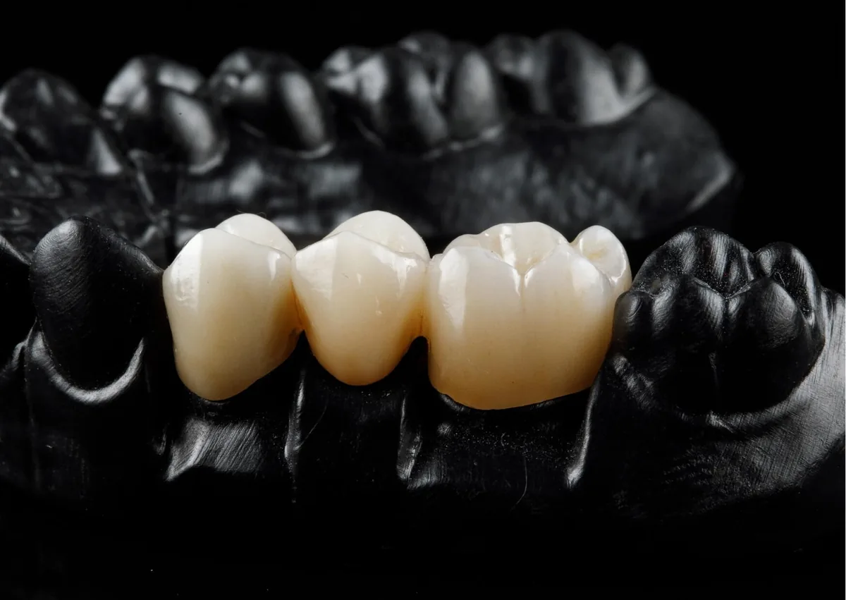 Dental crown restoration on a model showing one of the different types of dental crowns available.