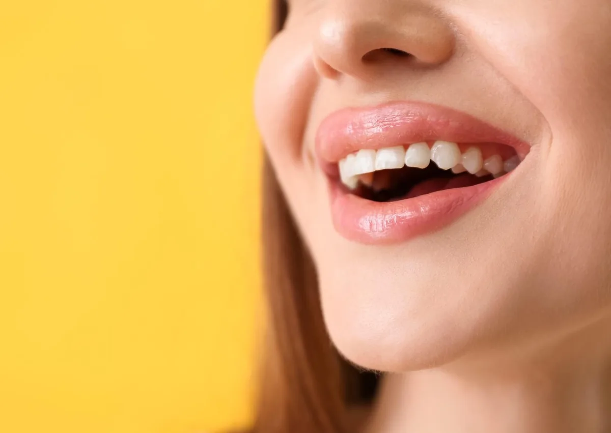 Close-up of a woman’s smile showing the gums and teeth after cosmetic gum contouring.