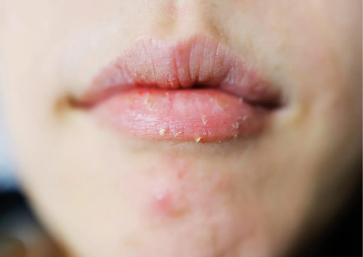 Close-up of dry, cracked lips that may accompany persistent dry mouth.