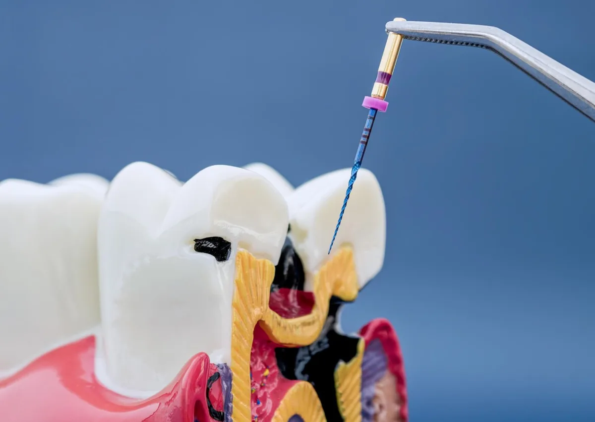 Close-up dental model showing dark cavities and tooth decay inside a molar, with a dental instrument illustrating cavity treatment.